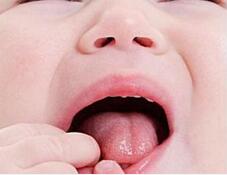 口腔溃疡怎么办？中医偏方助你摆脱困扰