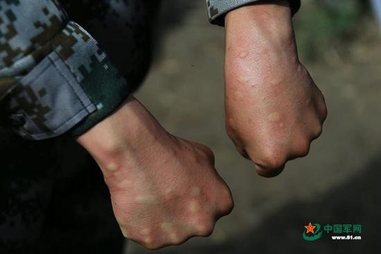 虽然戴着防蚊帽，穿着防护服，但巡逻回来，官兵的手上仍被蚊子叮起好多包。