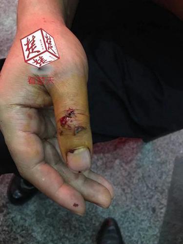 醉酒男咬警察手指5分钟不放 民众用钥匙帮撬嘴