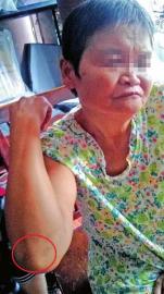 老人称摔倒后其肘部、腿部多处擦伤