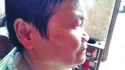 老人被冲倒后摔伤的痕迹至今还在