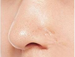 长期不清理黑头的危害 3招教你祛除黑头