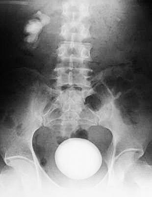 小伙长罕见膀胱巨石 15年从花生米成鹅蛋大