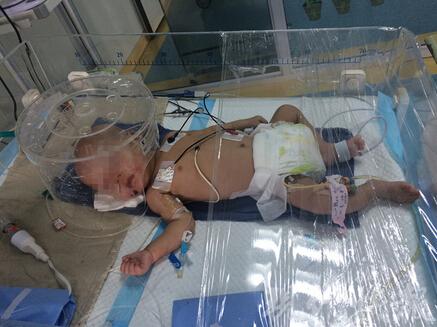 三个月大男婴头颅出血 身上多处骨折疑遭虐待