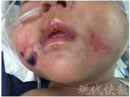 三个月大男婴头颅出血 身上多处骨折疑遭虐待