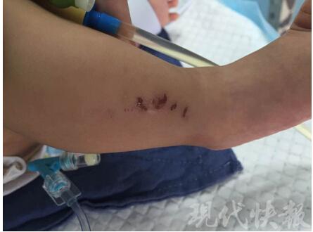 三个月大男婴头颅出血 身上多处骨折疑遭虐待