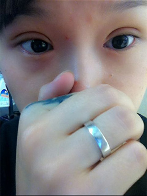 割双眼皮后热敷还是冷敷好？