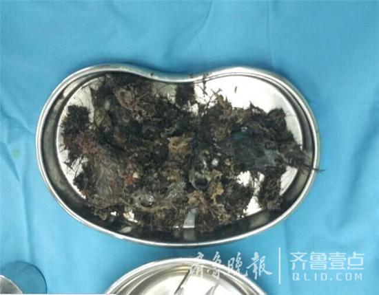 青岛女童妙妙（化名）今年5岁了，最近一段时间，妙妙的父母发现女儿经常喊肚子疼，于是夫妻俩就带着女儿到青岛的各大医院就诊，但是一直没检查出原因。8月初，妙妙在爸爸妈妈的陪同下来到青岛市妇女儿童医院外科门诊就诊。