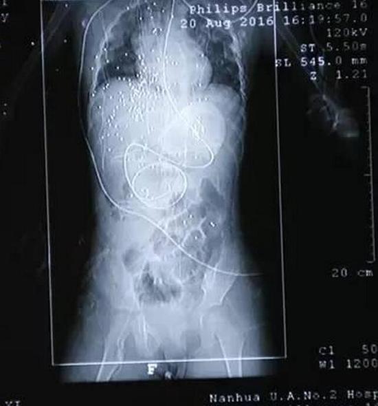 衡阳4岁女孩被火铳击中 一百多颗钢珠打入体内