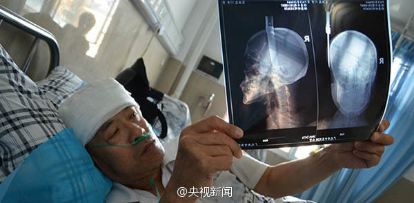 天降飞刀插入头顶 盘点大难不死的强人们