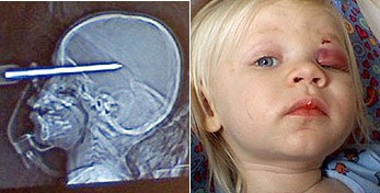 刀插入英国小女孩的左眼，奇迹生还