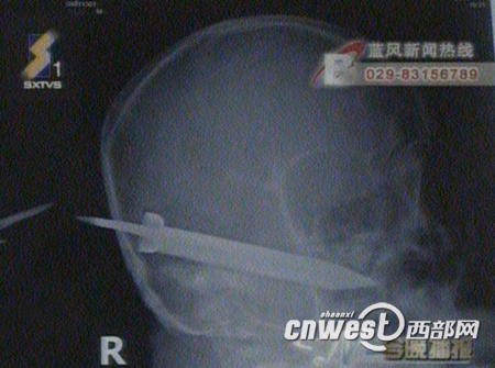 三棱刀插入头顶