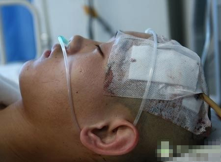 男孩与人争执，尖刀插入太阳穴