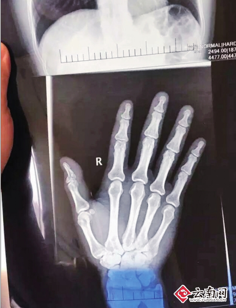 网曝老师帮女儿发小广告被小区保安群殴手指骨折物管:是他自己摔倒