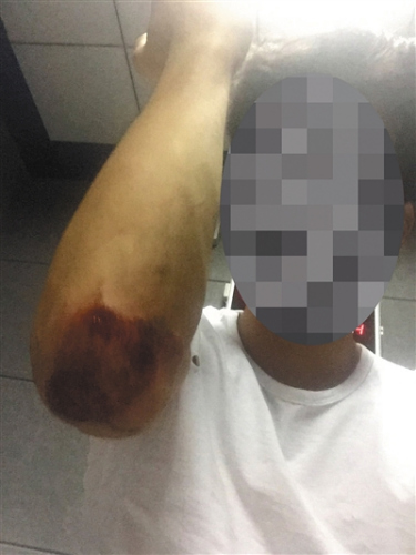 被警方抓捕时，不知情的黄诚进行了反抗，导致胳膊肘擦伤。