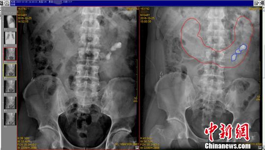 双肾相连长成马蹄肾 双肾相连长成马蹄肾