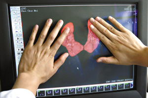 双肾相连长成马蹄肾3 双肾相连长成马蹄肾3