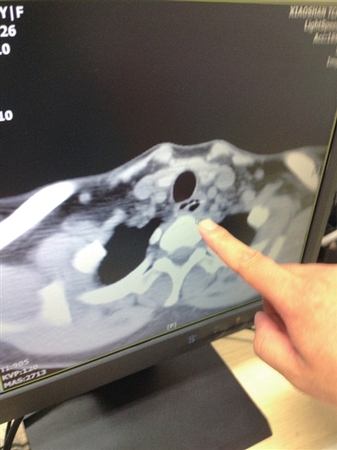 6厘米长鱼刺体内游荡 6厘米长鱼刺体内游荡