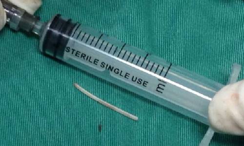 6厘米长鱼刺体内游荡3 6厘米长鱼刺体内游荡3