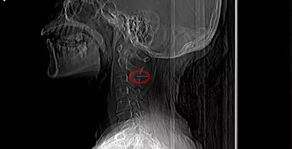 女子“坐立不安”两年多 竟是6厘米长鱼刺在“游荡” 女子“坐立不安”两年多 竟是6厘米长鱼刺在“游荡”