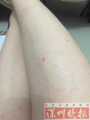 女子入住深圳一酒店 半夜醒来床上惊现十几只臭虫