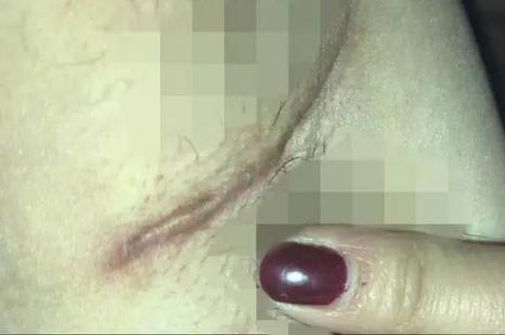 女子花两万隆胸伤口腥臭 女子花两万隆胸伤口腥臭