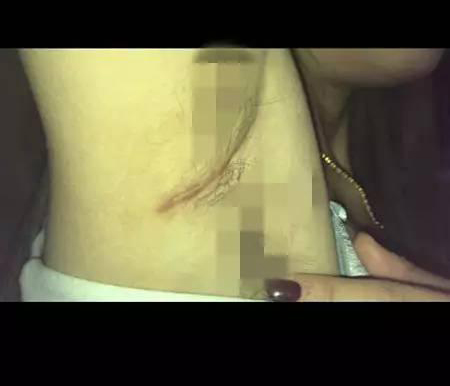 女子花两万隆胸伤口腥臭2 女子花两万隆胸伤口腥臭2