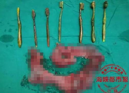 未婚女子肚里有7把牙刷 因春节遭遇逼婚后自残