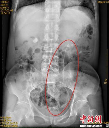 四川一男子体内藏30厘米医用导管七年浑然不知(图)