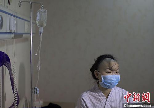 女子拒绝复婚被前夫咬掉鼻子 取肋软骨重造鼻