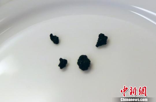 辣条当早餐四川9岁男童患上胆囊结石