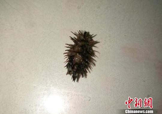 四川女子喉咙呛入苍耳险致命