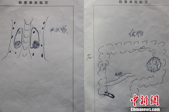 聂继光绘就的病情图纸 龚波 摄 聂继光绘就的病情图纸 龚波 摄