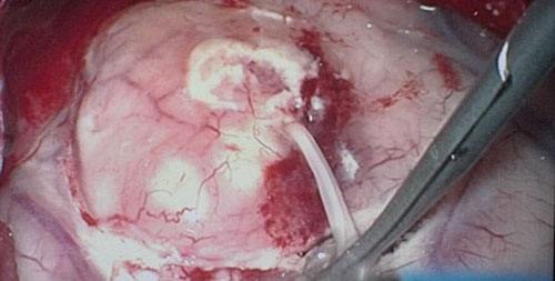 老太眼内8条活虫2