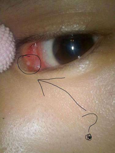 老太眼内8条活虫 老太眼内8条活虫