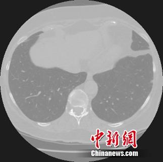 阿里云启动天池医疗AI大赛挑战早期肺癌诊断