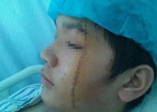 男生与同学产生口角被按地上刀割双脸 老师不在场