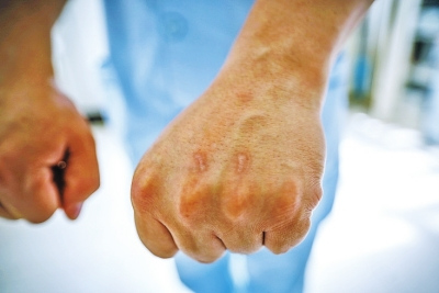 护士被病人抓伤是常事。