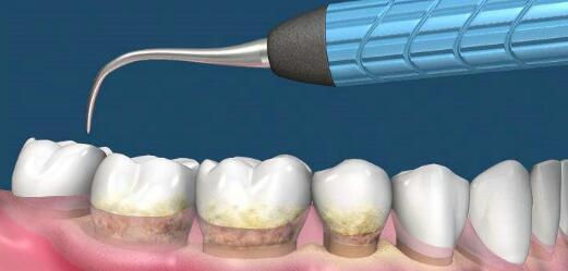 慎用牙签？牙缝真的越剔越大吗