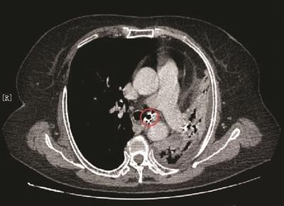 阿姨咳嗽十几年，把左肺咳“没”了？