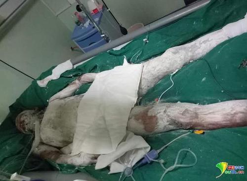 研究生触碰高压线致全身70%烧伤 因家贫求安乐死