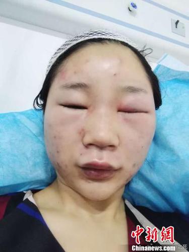 图为当事人提供的伤情图。　网络图摄