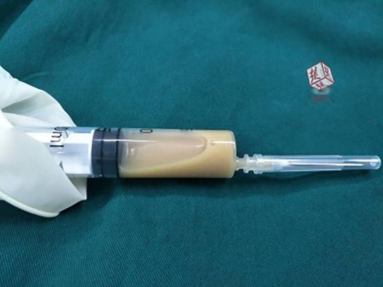 抽出来的脓液。