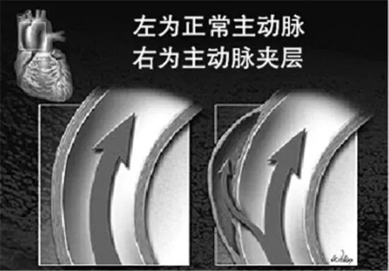 女子腹部剧痛第二天便去世 医生:这种病冬季高发