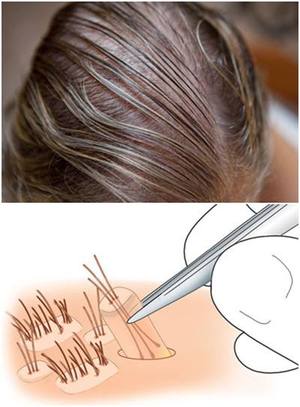 染烫会不会导致种植后的头发脱落？