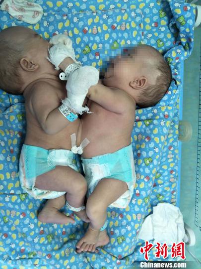 图为腹部连体男婴?！∈?摄