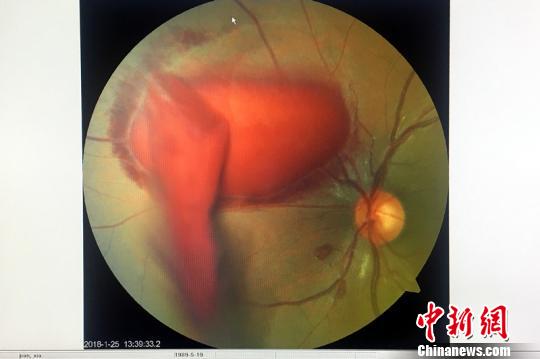 小潘的眼底照相检查图，红色块为眼底出血血块?！≈有?摄