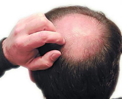 聪明绝顶？秃顶这件事 为何传男不传女？