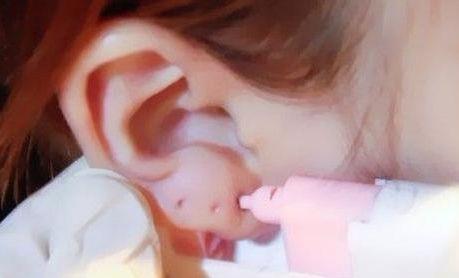 女子路边摊打耳洞 5年后耳垂变肉瘤