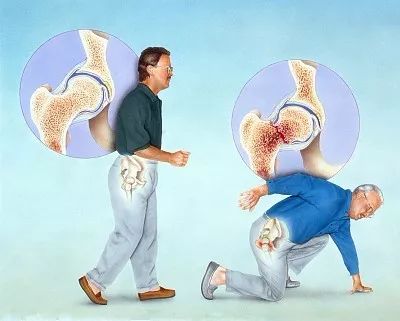 骨质疏松性骨折的特点: